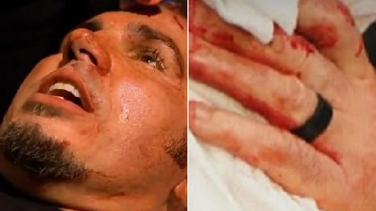 Matt Hardy Gets 13 Stitches After AEW Dynamite This Week